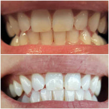 Load image into Gallery viewer, Snow® At-Home Teeth Whitening (ALL-IN-ONE KIT)