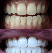 Load image into Gallery viewer, Snow® At-Home Teeth Whitening (ALL-IN-ONE KIT)