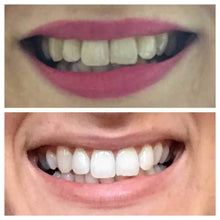 Load image into Gallery viewer, SNOW Teeth Whitening + Lip Balm Bundle