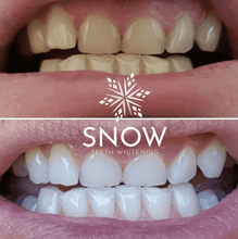 Load image into Gallery viewer, Snow® Teeth Whitening At-Home System [All-in-One Kit] - $99
