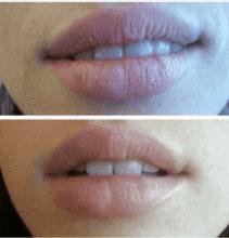 Load image into Gallery viewer, Perfect Kiss Kit
